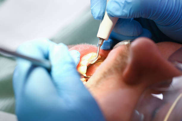 Best Emergency Dental Care for Broken or Chipped Teeth in Mission, SD