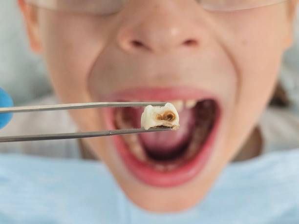 Best Emergency Root Canal Treatment in Mission, SD